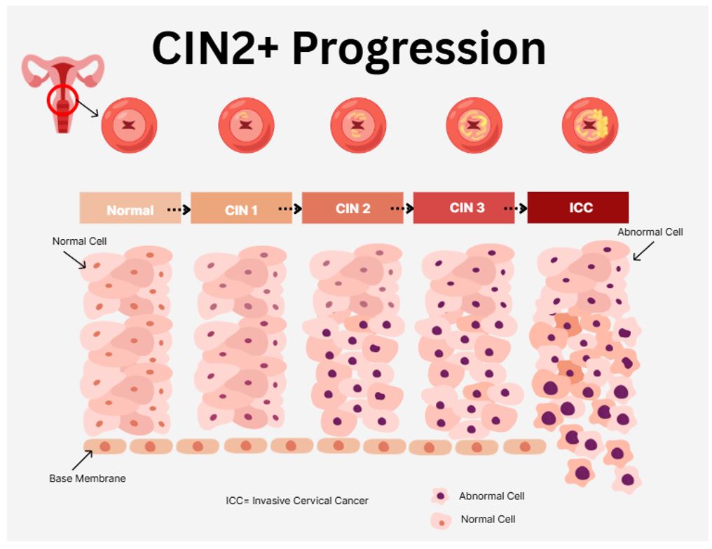 CIN2+ Progression Drawing.JPG