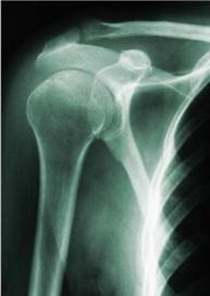  image of shoulder x-ray