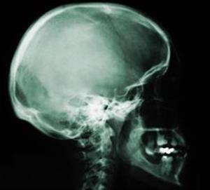 xray showing side view of a human skull