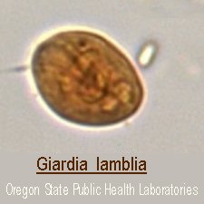 West mount cyst: Giardia lamblia